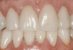 Marc H Berley, DMD | Crowns  amp  Caps, Invisalign reg  and Preventative Program